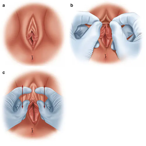 عمل جراحی زیبایی 
هودوپلاستی (Hoodoplasty) 