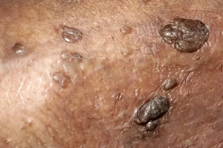 ضایعات HPV ضایعات HPV